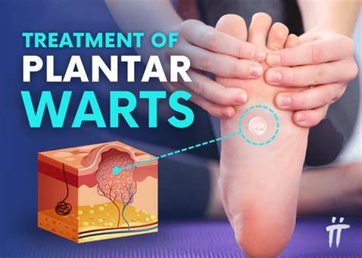 How much does it cost to surgically remove a plantar wart?