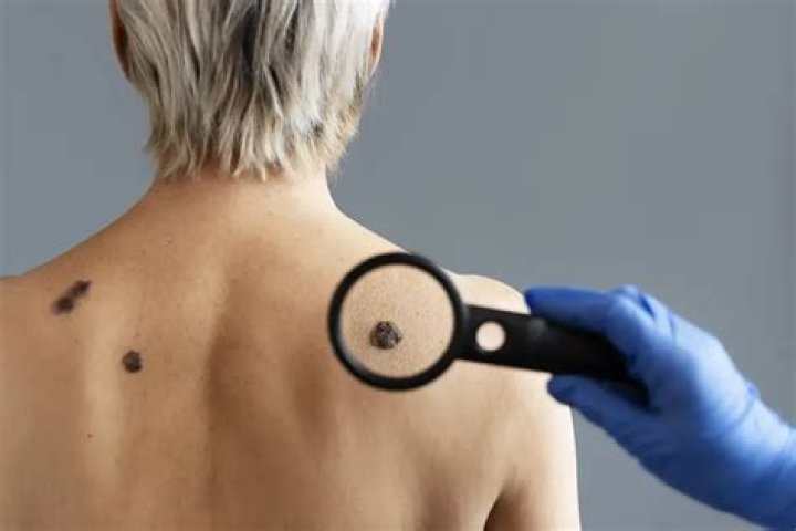How quickly should melanoma be removed?