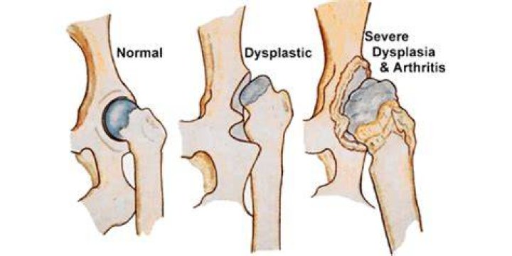 How serious is mild dysplasia?