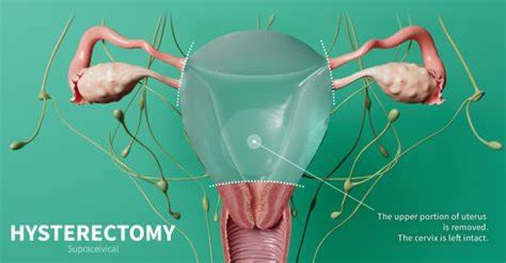 Is a total hysterectomy considered major surgery?
