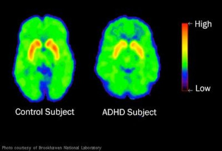 Is ADHD a chemical imbalance?