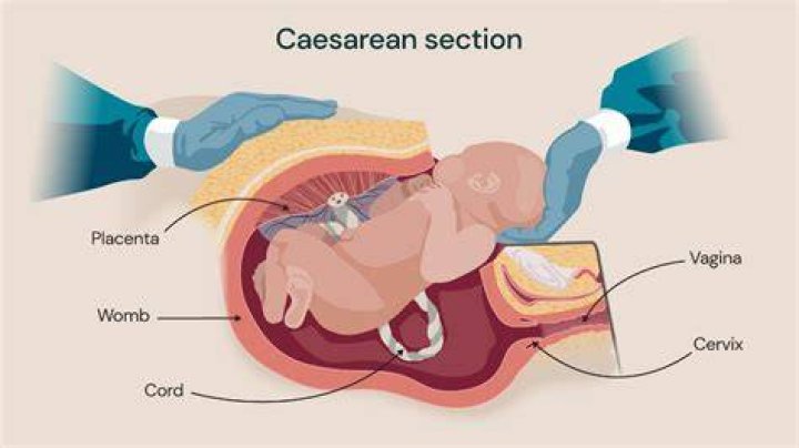 Is C-section or vaginal birth safer?