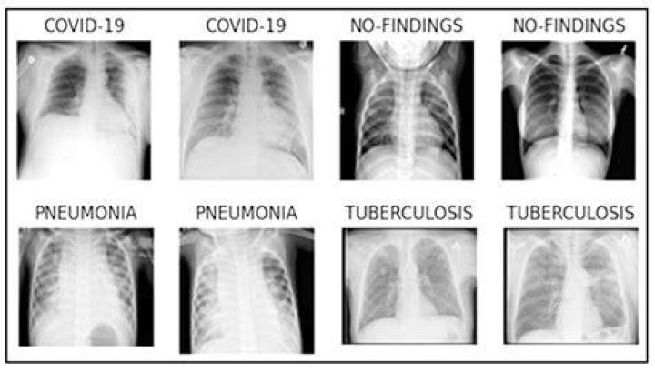Is Covid pneumonia different than regular pneumonia?