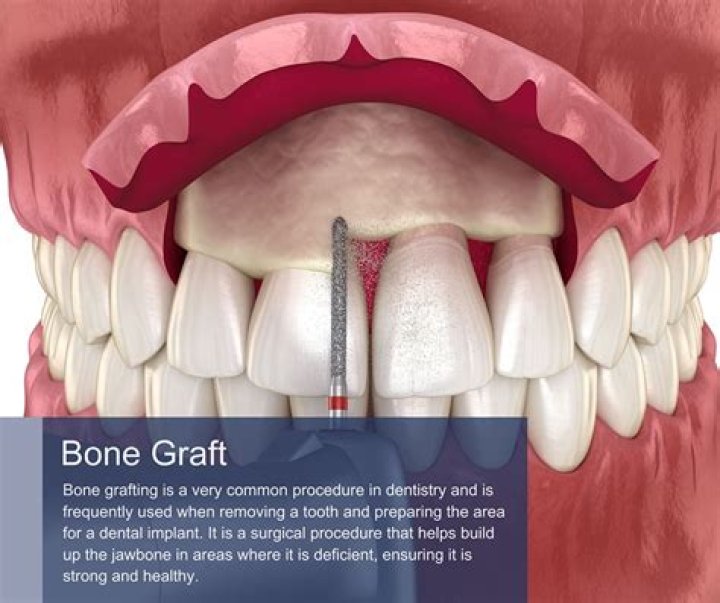 Is dental bone graft surgery painful?