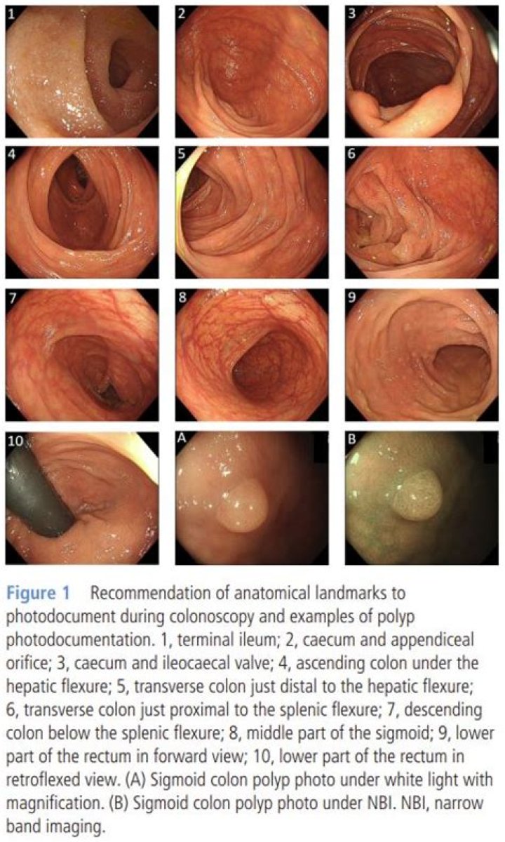 Is it normal to find polyps during endoscopy?
