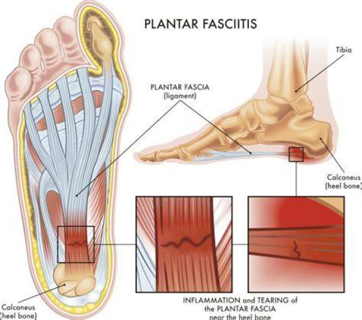 Is plantar fasciitis caused by being overweight?