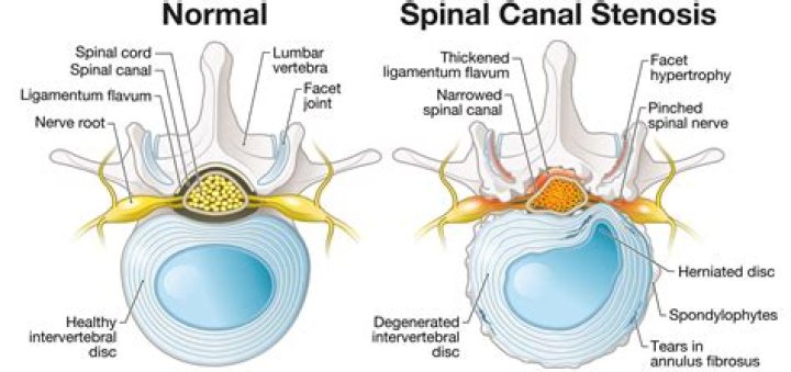 Is spinal stenosis a terminal?