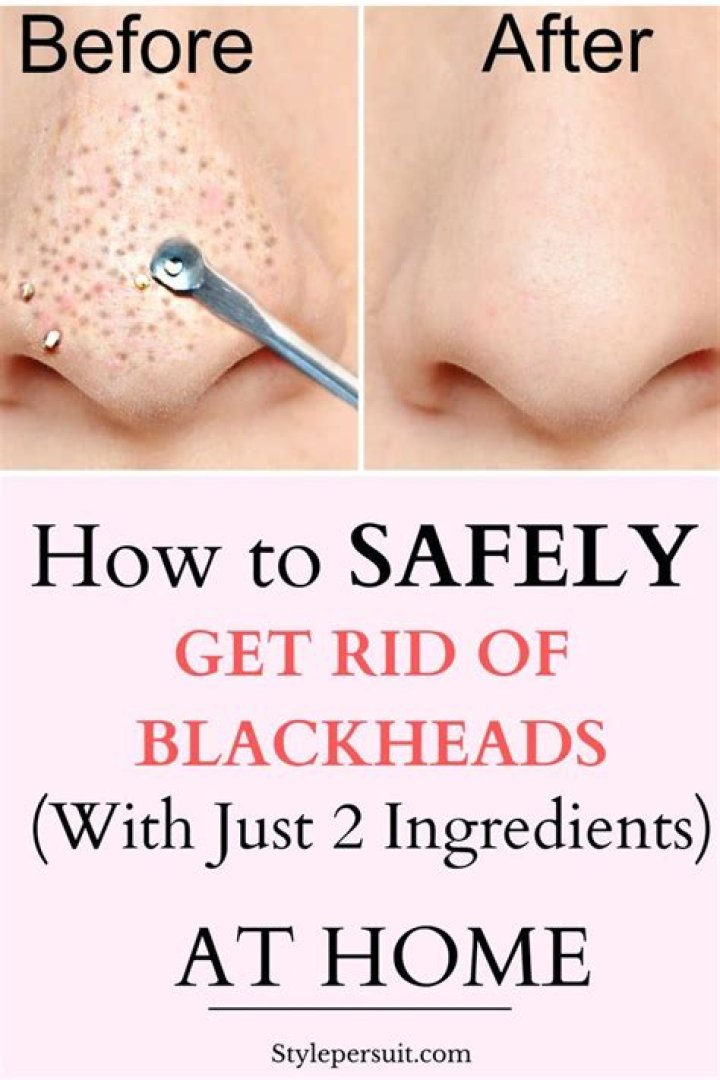Is toothpaste good for blackheads?