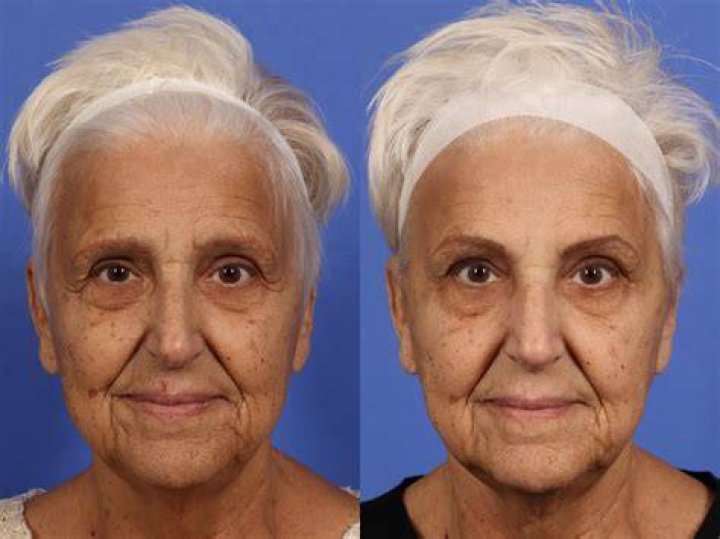 Should 60 year olds get Botox?