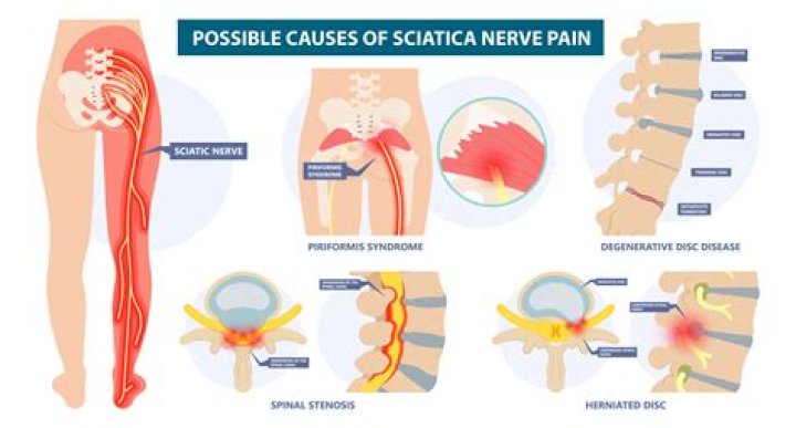 Should you go to ER for sciatica?