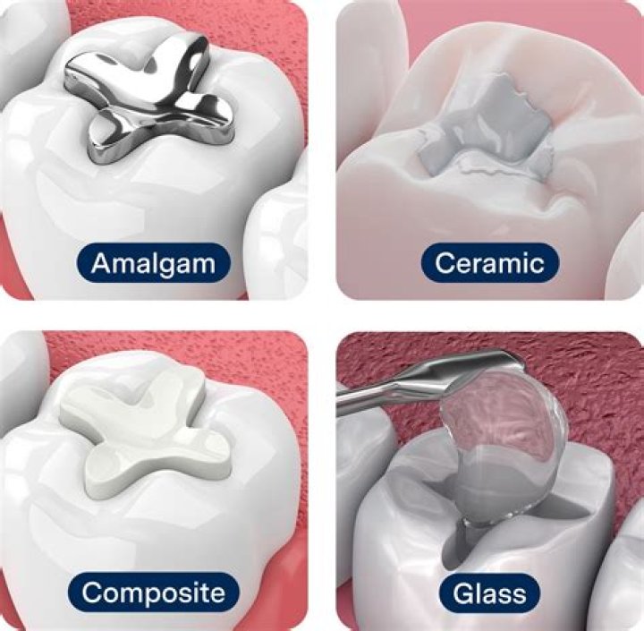What are porcelain fillings?