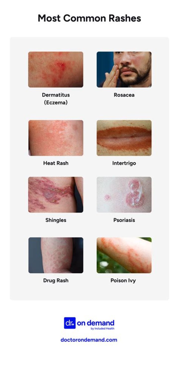 What are the 5 types of rashes?