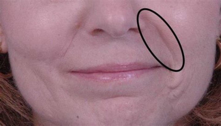 What are the lines between your nose and mouth called?