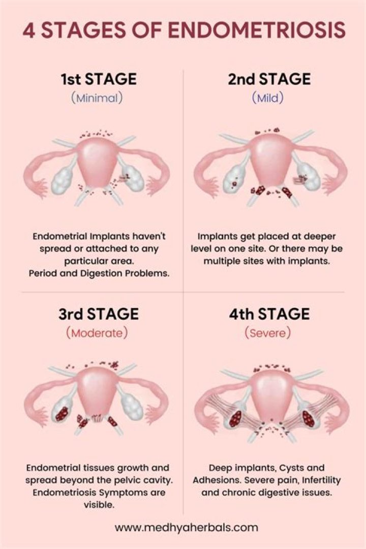 What are the stages of endometriosis?