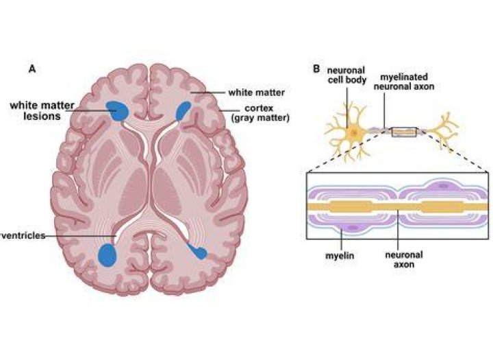 What are the symptoms of white matter lesions?