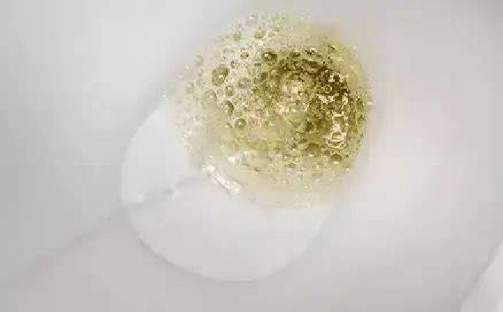 What are the white bubbles in urine?