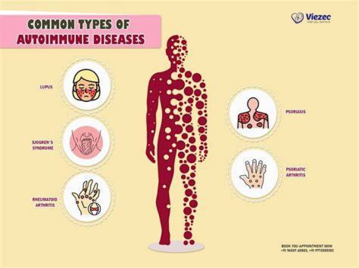 What autoimmune disease causes hand swelling?