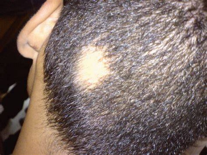 What causes small bald spots on scalp?