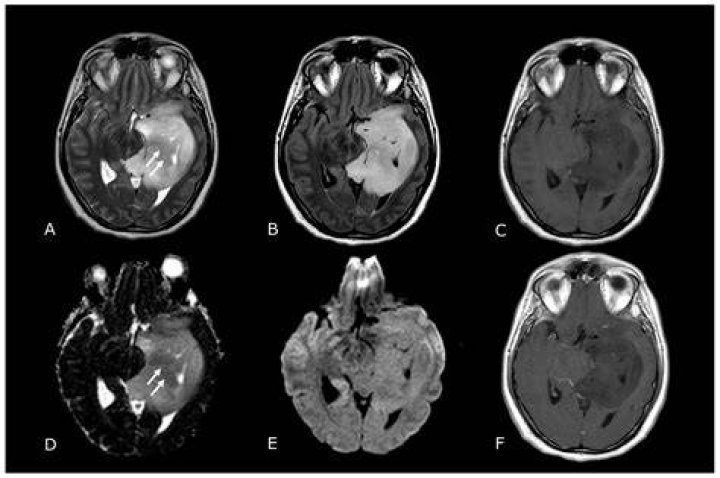 What color are tumors on MRI?