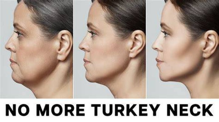 What cream is best for turkey neck?