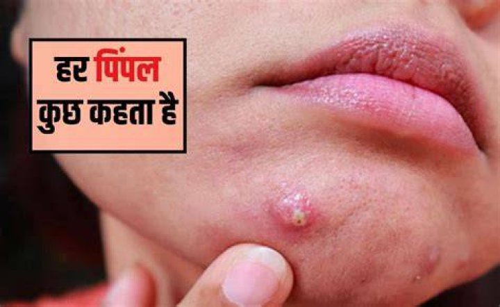 What deficiency causes pimples?