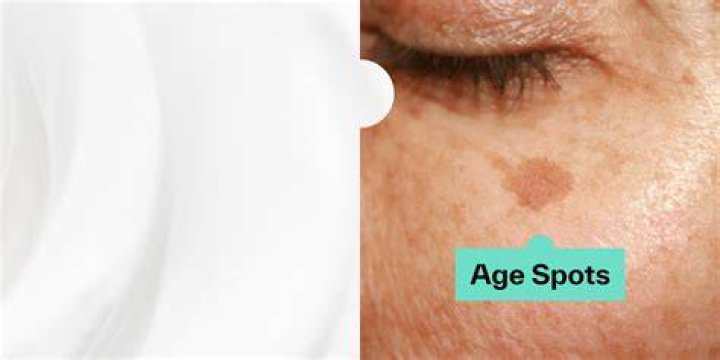 What do dermatologists recommend for age spots?