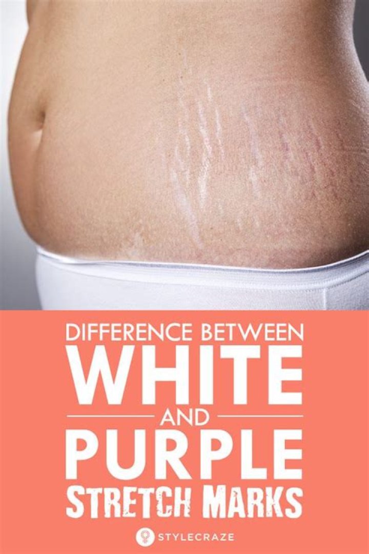 What do white stretch marks mean?