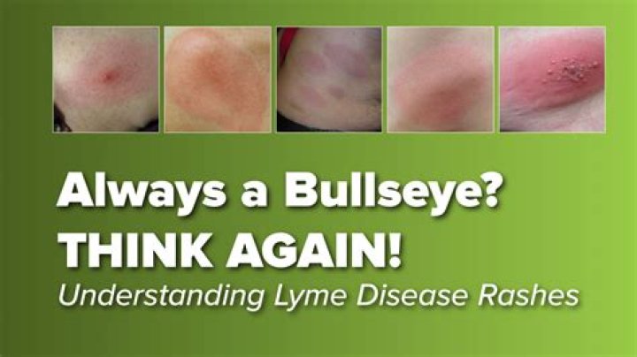 What does a bullseye rash look like?
