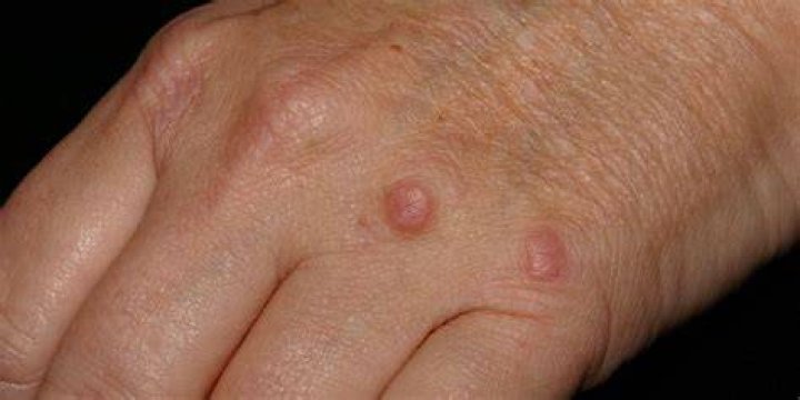 What does a suture granuloma look like?