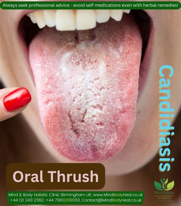 What does a tongue with thrush look like?