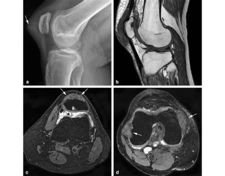 What does gout in the knee feel like?