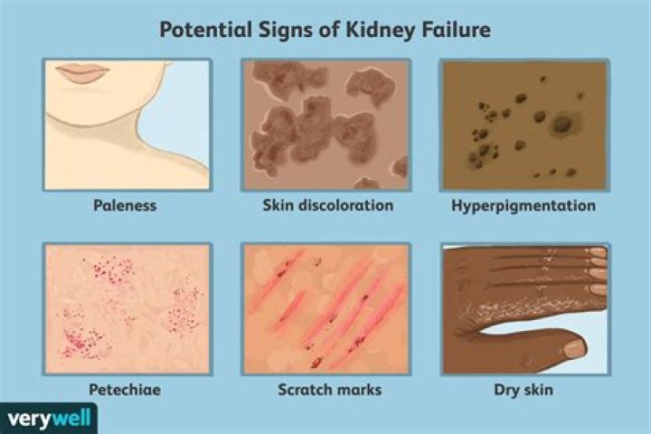 What does kidney failure skin look like?