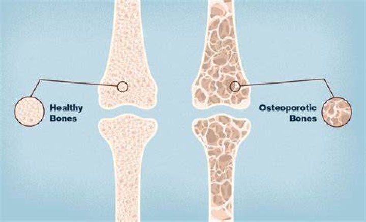 What does osteoporosis do to teeth?