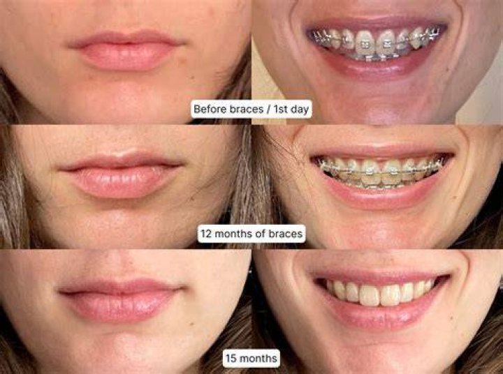 What does the first month of braces do?