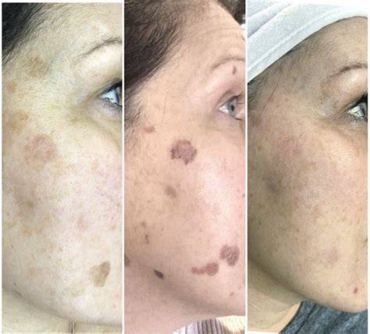 What does your face look like after laser treatment?