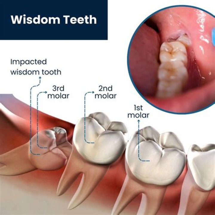 What happens if I don't remove my wisdom teeth?