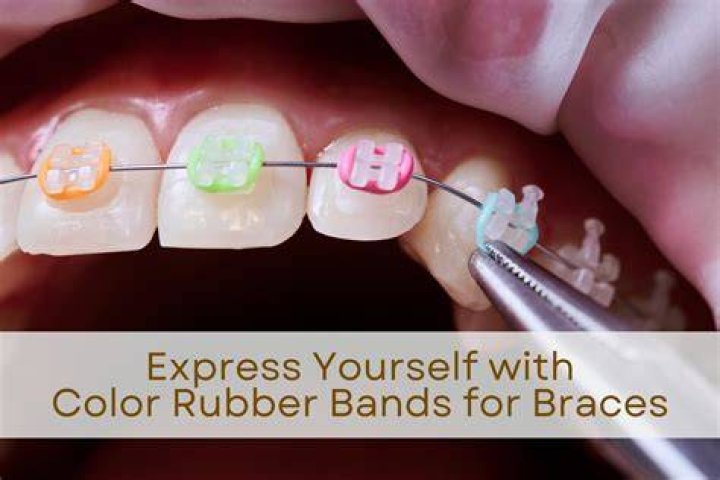 What happens if you double up on your rubber bands for braces?