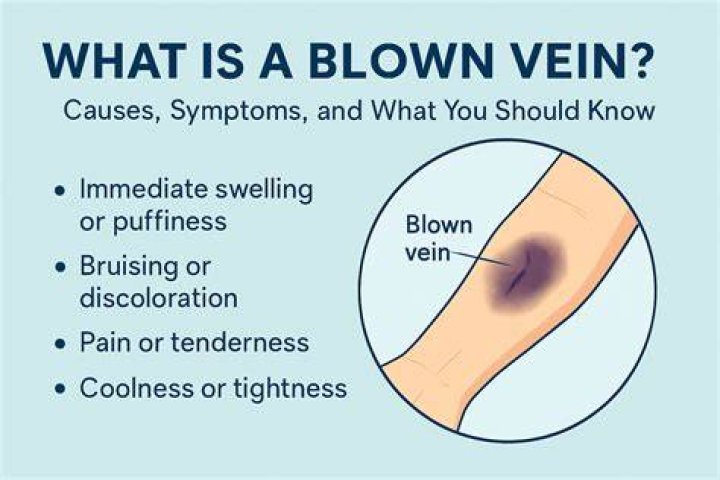 What happens if you pop a vein?