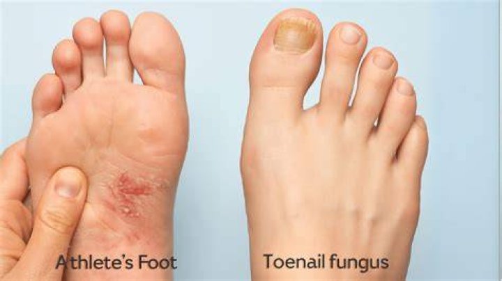 What happens if you touch toe fungus?