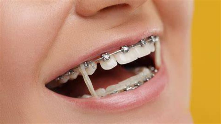 What happens if you wear the wrong size rubber bands on braces?