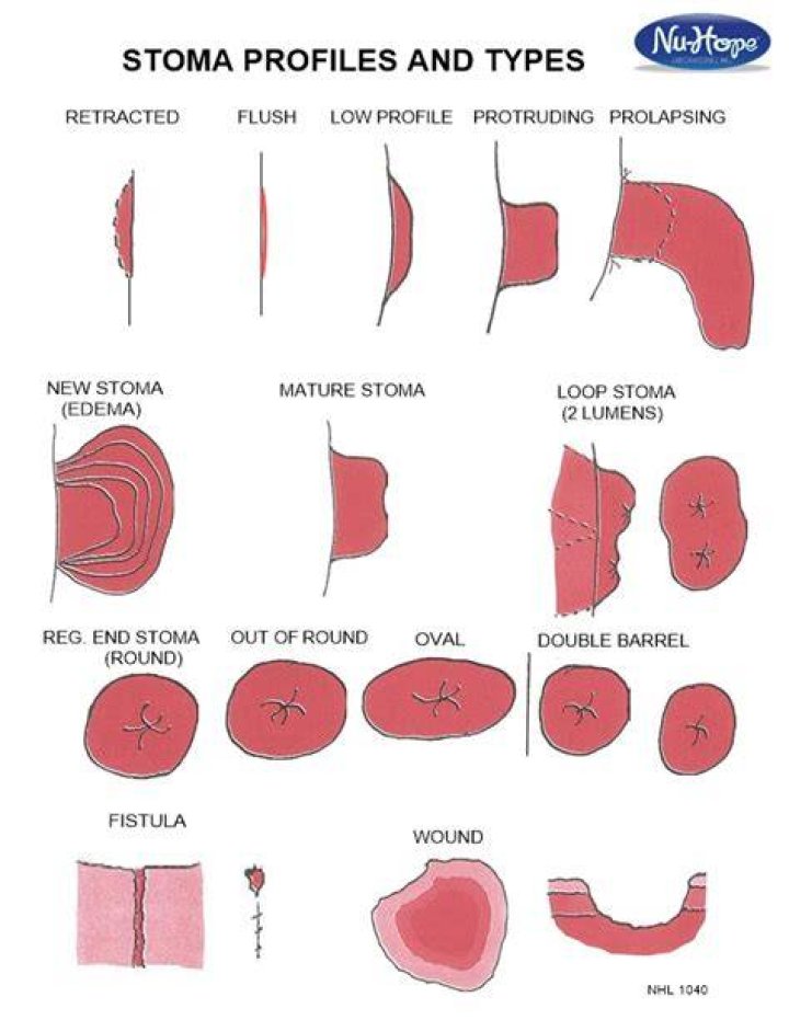 What is a double stoma?
