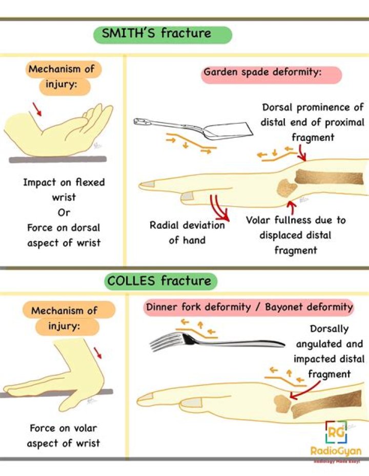 What is a fracture deformity?