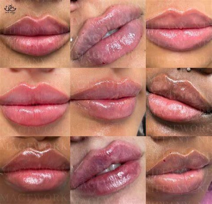 What is a Russian lip lift?