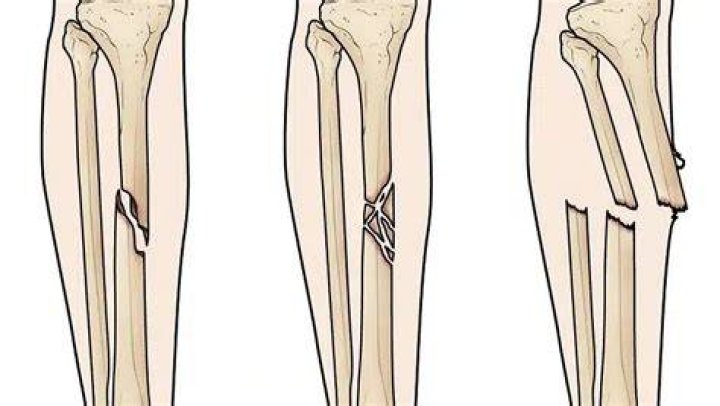 What is butterfly fracture?