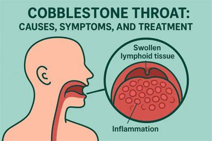 What is cobblestone throat?