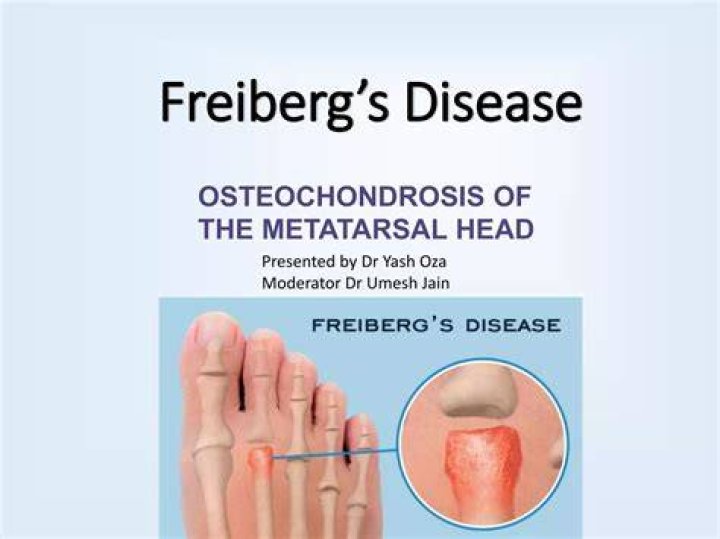 What is Freiberg's disease?