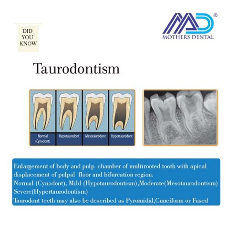 What is hyper taurodontism?
