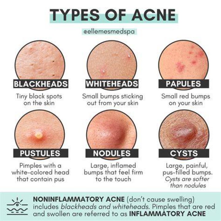 What is Pearl acne?