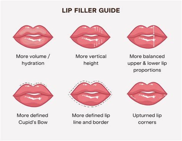 What is the best filler for vertical lines above lips?