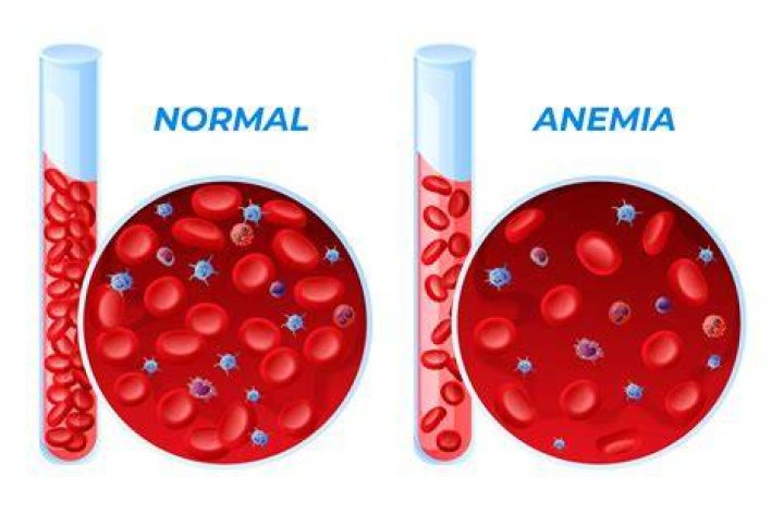 What it's like living with anemia?